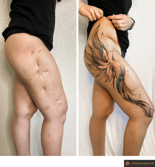 Covering tattoo chirurgie